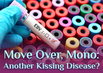 Santa Fe dentist, Dr. Giron at Vida Dental Studio, talks about a kissing disease you might be less familiar with than mononucleosis.