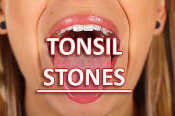 Santa Fe dentist, Dr. Giron at Vida Dental Studio, tells patients about what causes tonsil stones and how to treat and prevent them from forming.