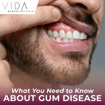Understand the causes, symptoms, and prevention strategies for gum disease. Learn how proactive care and regular dental visits at VIDA Dental Studio in Santa Fe can protect your oral health.